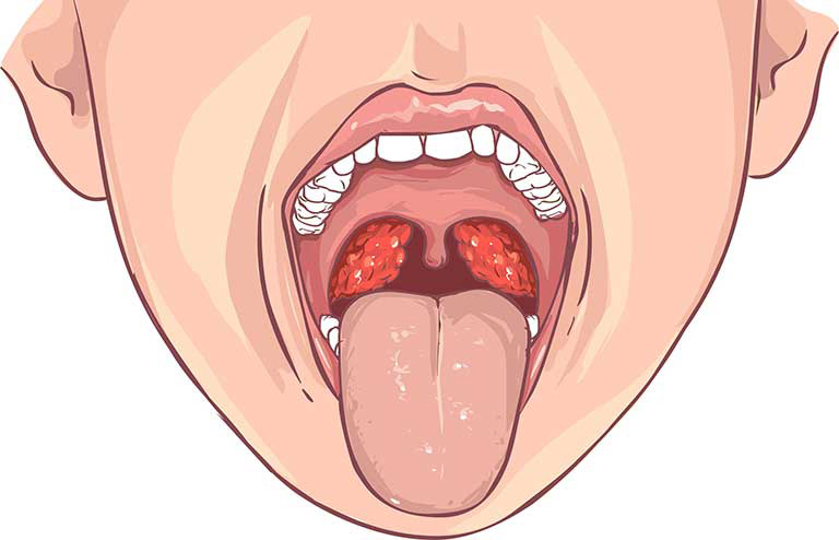 hình ảnh viêm vòm họng