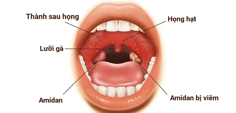 viêm hầu họng có tăng sinh mô hạt