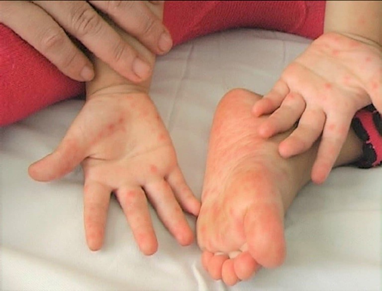 Bệnh tay chân miệng: Dấu hiệu nhận biết, điều trị & phòng ngừa