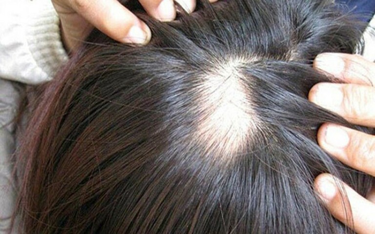 cách chữa rụng tóc hói đầu