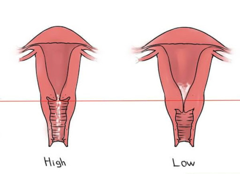 Cổ tử cung cao có ảnh hưởng gì?