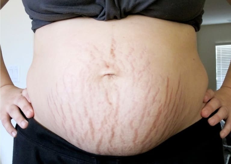 Tổng hợp hình ảnh rạn da khi mang thai và rạn da sau sinh