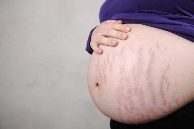 Hình ảnh rạn da khi mang thai 