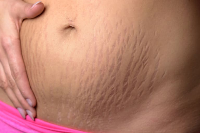Hình ảnh rạn da khi mang thai và sau sinh – Nhìn & cảm nhận