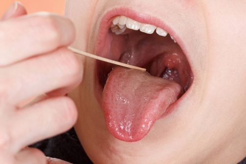 Hình ảnh viêm họng (hạt, cấp - mãn tính) và họng bình thường