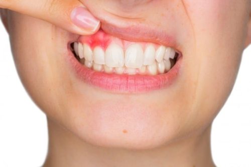 Các bệnh về răng miệng thường gặp và cách xử lý