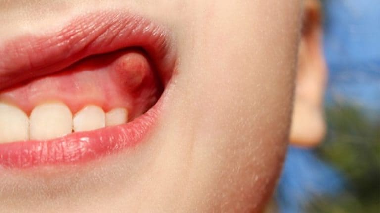 những bệnh lý răng miệng thường gặp