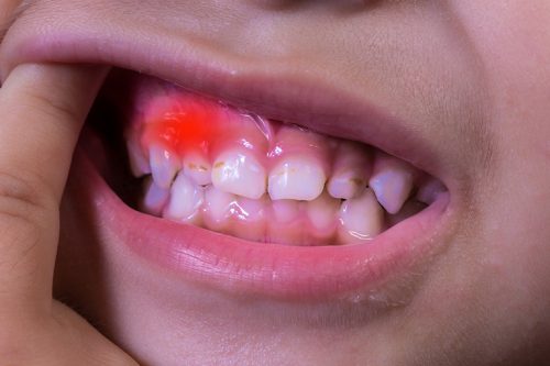 viêm nướu răng ở trẻ em