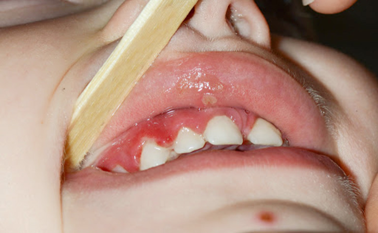 trẻ bị viêm nướu răng