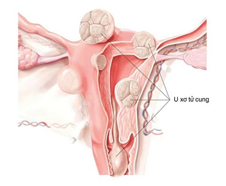 Điều trị u xơ tử cung không cần phẫu thuật và lưu ý