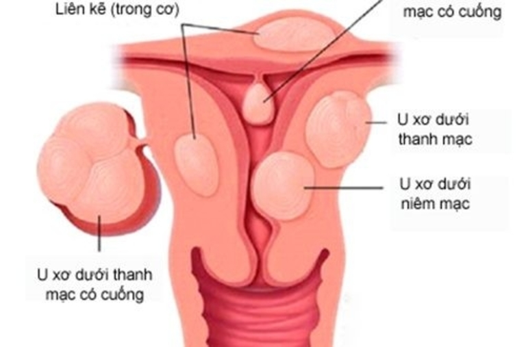 U xơ tử cung có dẫn đến ung thư không?