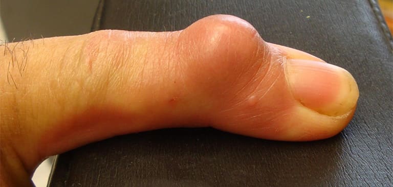 Nổi cục ở đốt ngón tay là bệnh gì?