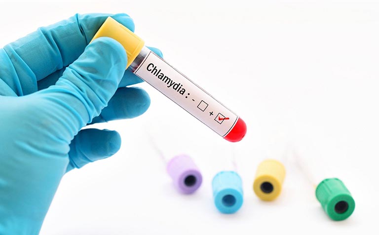 xét nghiệm chlamydia mãn tính