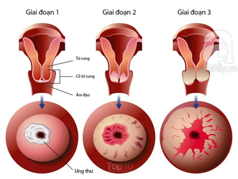 Dấu hiệu ung thư cổ tử cung giai đoạn 1 và cách trị