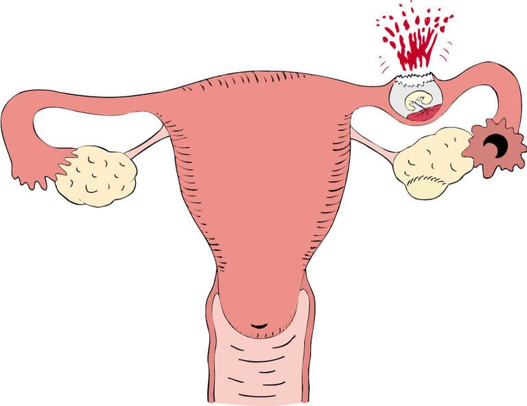 Cách xử lý thai ngoài tử cung