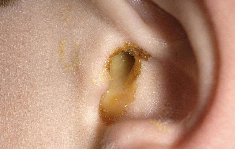 Bị lùng bùng lỗ tai là bệnh gì? Làm sao hết?