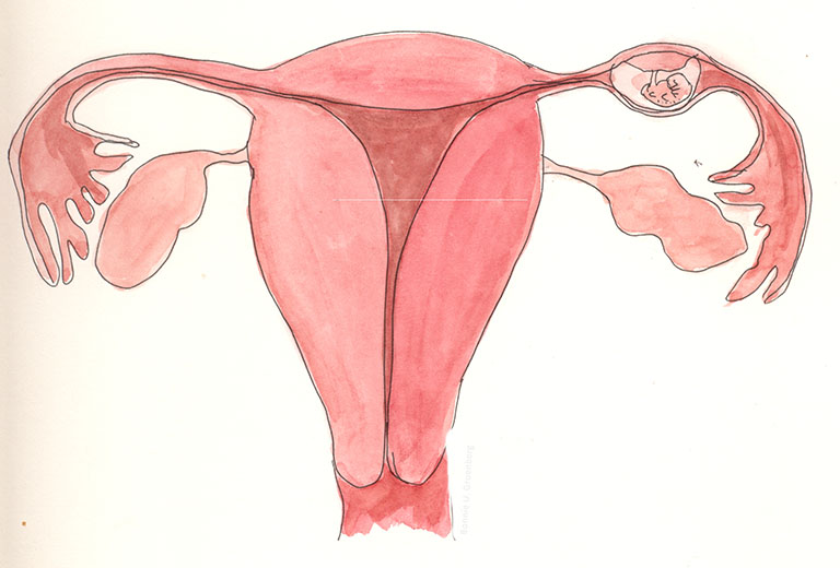 Mang thai ngoài tử cung thử que có biết không?