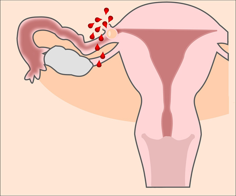 Mổ nội soi thai ngoài tử cung