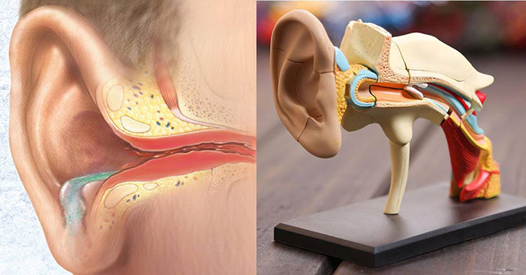 Viêm tai giữa mạn tính có cholesteatoma