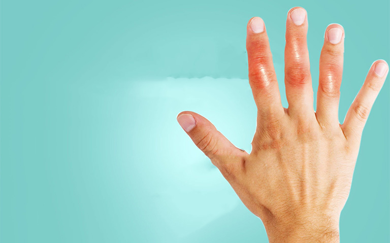 Bệnh viêm khớp ngón tay là gì