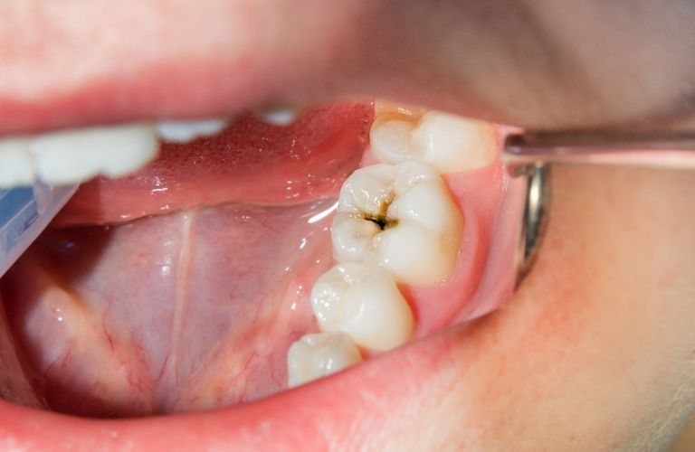 Bệnh lý răng miệng là vấn đề chung của hầu hết tất cả mọi người