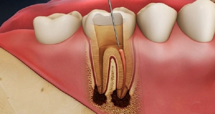 Nhiều biến chứng khó lường từ sâu răng nếu không được điều trị kịp thời