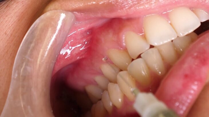 Răng số 5 là chiếc răng hàm nhỏ thứ 2 trong khuôn hàm