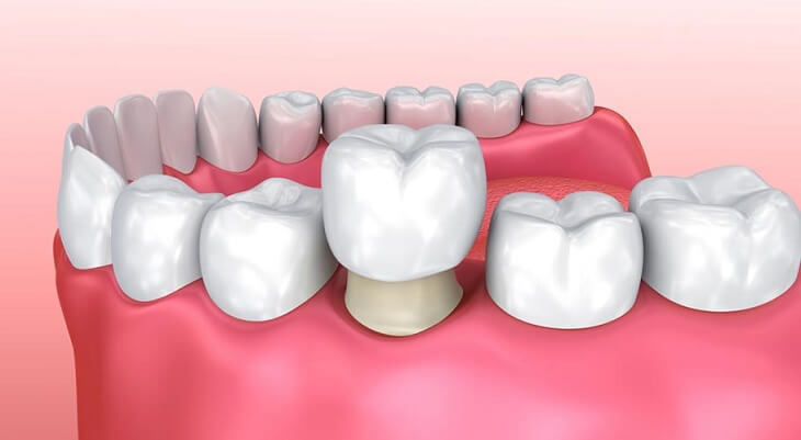 Bọc răng sứ để vi khuẩn gây sâu răng không lây lan và khôi phục chức năng của răng