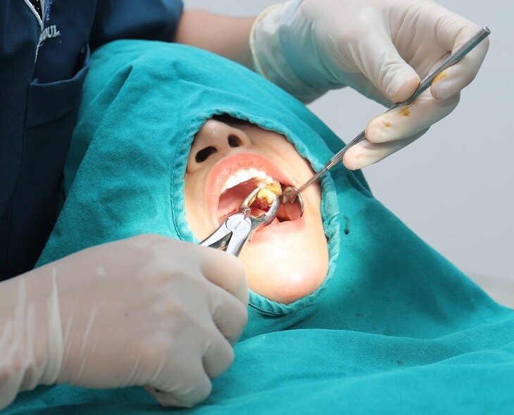 Việc nhổ răng không nguy hiểm nếu được thực hiện đúng kỹ thuật 