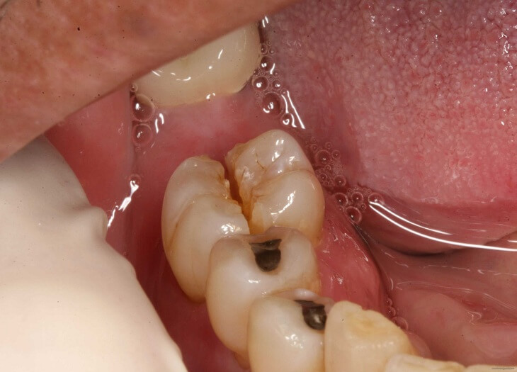 Răng tại vị trí số 6 rất dễ bị sâu nếu không được chăm sóc đúng cách