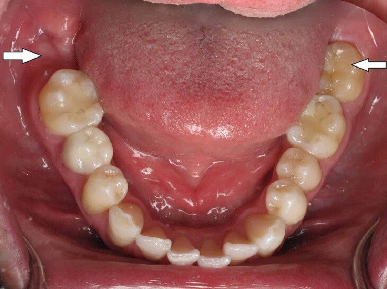 Trên sơ đồ răng, răng số bảy sẽ là răng cối thứ 2 trên khung hàm, thực hiện chức năng ăn, nhai