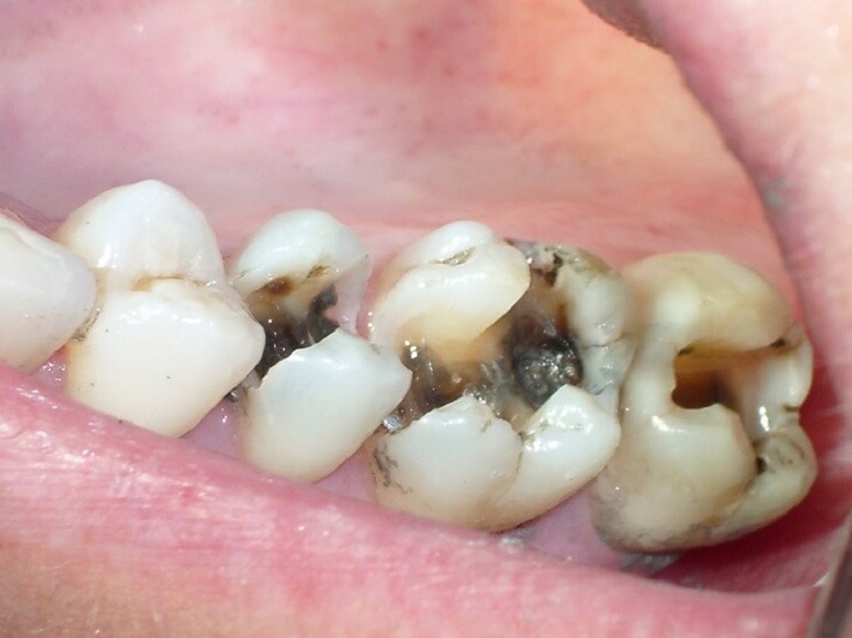Trường hợp răng bị sâu ở vị trí số 7 không nhất thiết phải nhổ bỏ