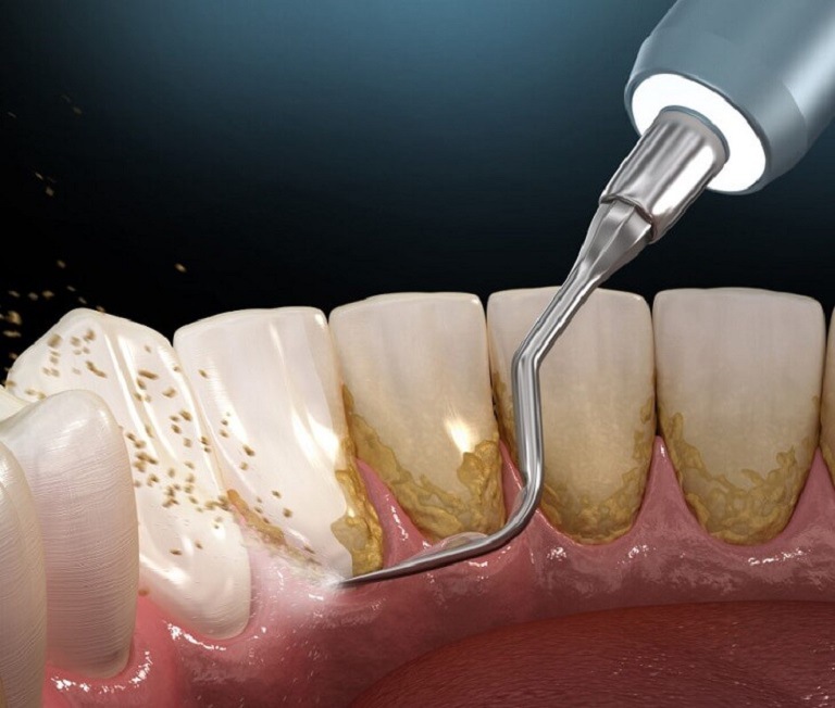 Cạo vôi răng định kỳ 6 tháng/ lần để phòng ngừa bệnh lý răng miệng