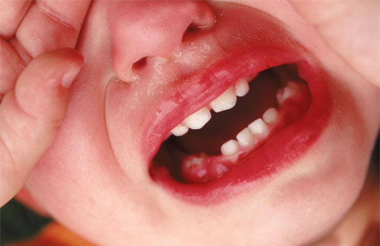 Triệu chứng nhận biết bé bị viêm lợi nhiệt miệng