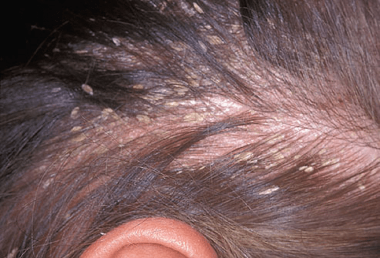 dấu hiệu nấm da đầu ở trẻ em 