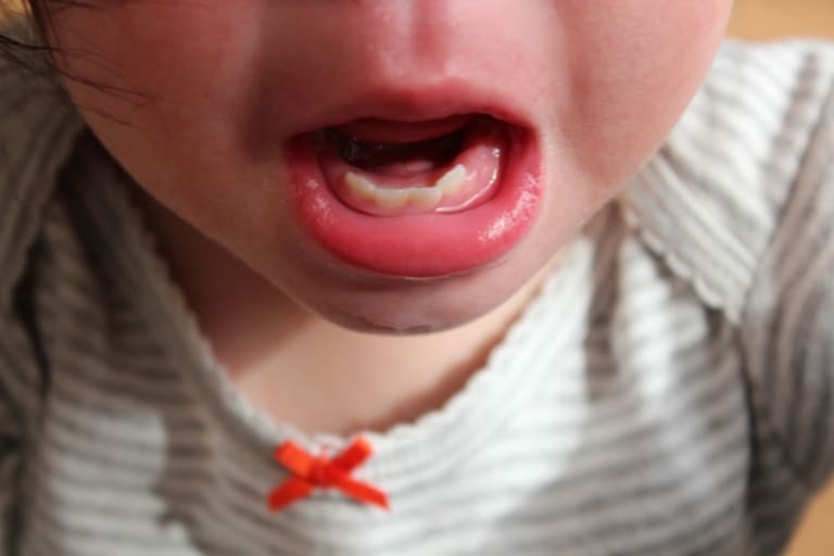 Trẻ bị viêm lợi và sốt có nguy hiểm không?