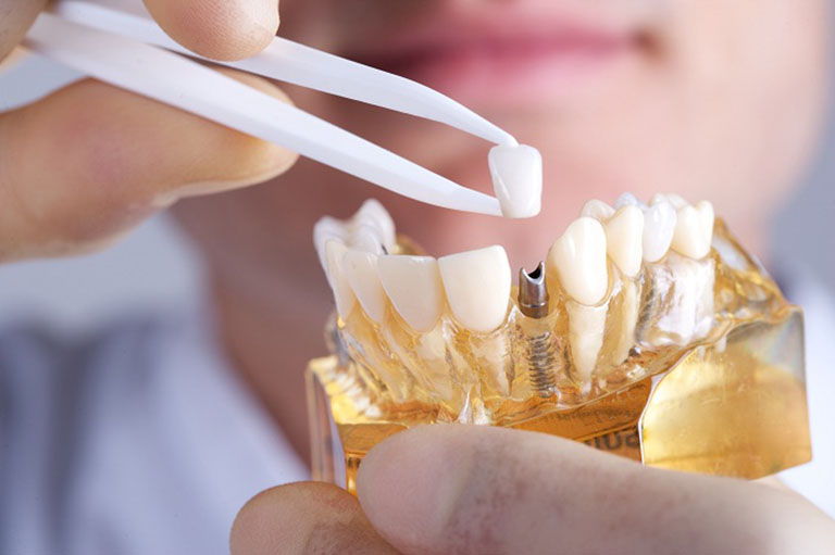 Trồng răng Implant là phương pháp được đánh giá là ít đau đớn nhất