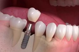 Trồng răng giả có đau không và những lưu ý khi trồng răng