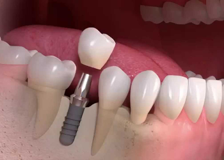 Trồng răng giả có đau không và những lưu ý khi trồng răng