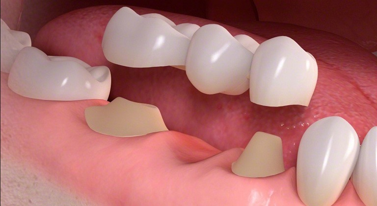 Trồng răng sứ mất bao lâu phụ thuộc vào nhiều yếu tố