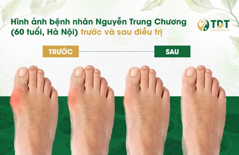 Hình ảnh bàn chân trước và sau điều trị của bệnh nhân Nguyễn Trung Chương