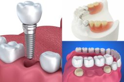 Trồng răng hàm có đau không phụ thuộc vào nhiều yếu tố