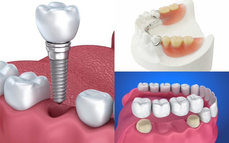 Trồng răng hàm có đau không phụ thuộc vào nhiều yếu tố