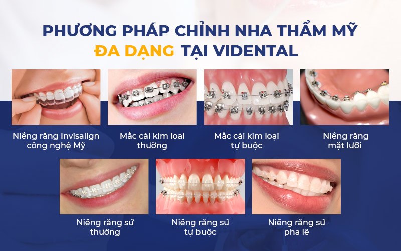 Vidental triển khai đa dạng các phương pháp niềng răng