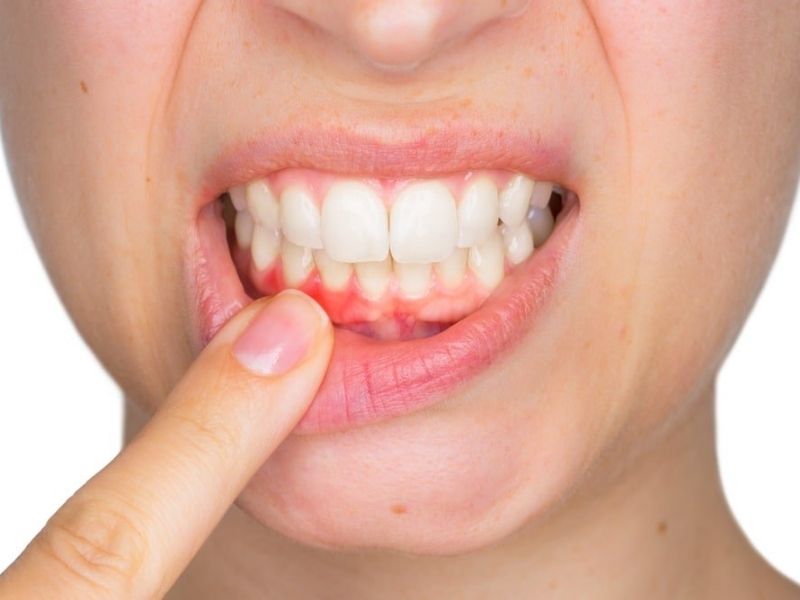 Mất răng tiềm ẩn nguy cơ gây nên bệnh lý răng miệng