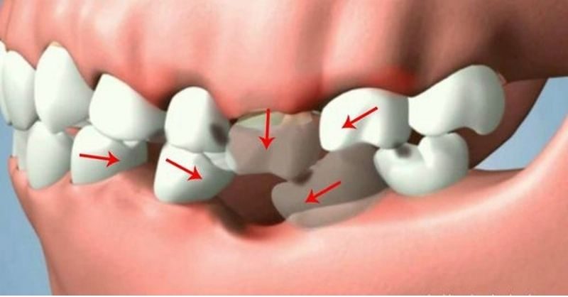 Nhổ răng không trồng lại có thể khiến khuôn mặt bị lão hóa sớm