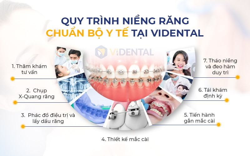 Quy trình niềng răng tại Vidental