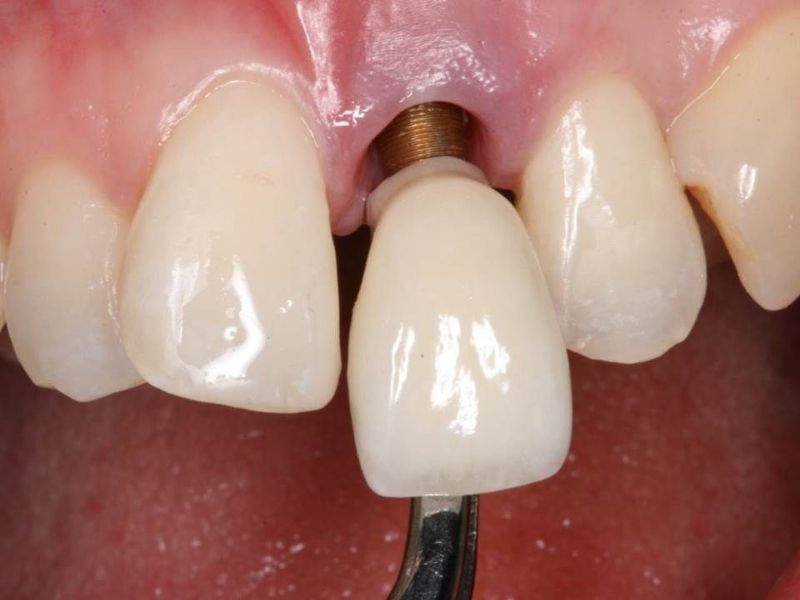 Lỏng vít dẫn đến khả năng ăn nhai kém, dễ rơi rụng răng sứ