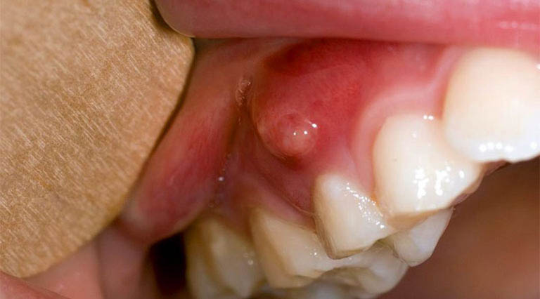 Nổi u cục ở nướu răng