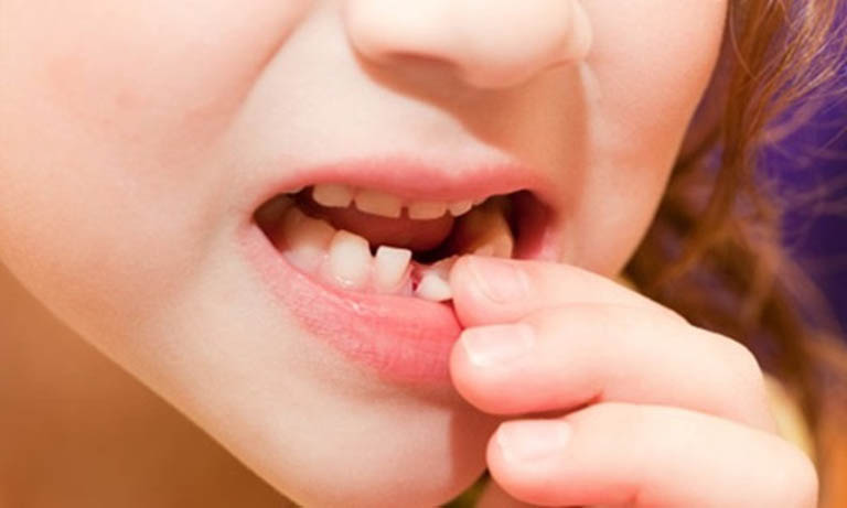 Nguyên nhân gây áp xe răng ở trẻ em 